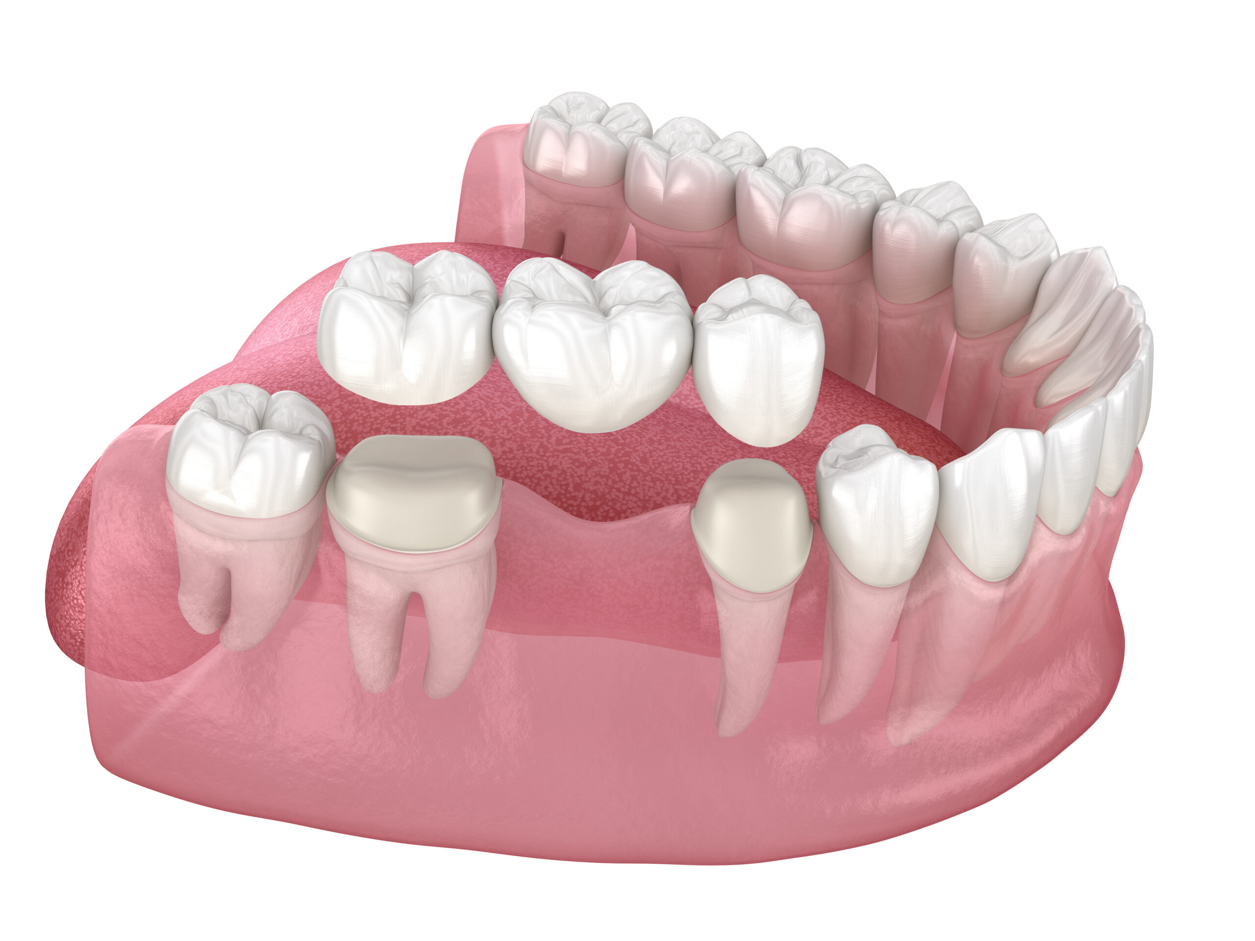 ブリッジと部分床義歯におけるむし歯の発生率とリスク